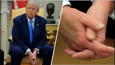 Trump Chronic Venous Insufficiency Diagnosis: What the Condition Is and How It's Treated