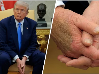 Trump Chronic Venous Insufficiency Diagnosis: What the Condition Is and How It's Treated
