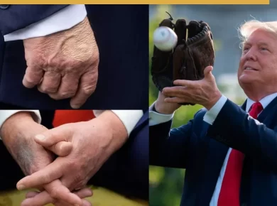 Trump hand bruise makeup: What the White House has said