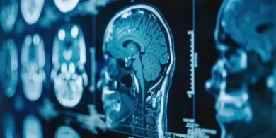 Gene Therapy Breakthrough for Huntington’s Disease 75% Progression Slowed