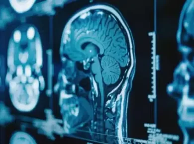 Gene Therapy Breakthrough for Huntington’s Disease 75% Progression Slowed